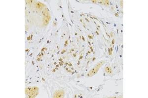 Immunohistochemistry of paraffin-embedded human stomach using Slug Antibody (ABIN6127298, ABIN6148181, ABIN6148183 and ABIN6217314) at dilution of 1:100 (40x lens). (SLUG 抗体  (AA 126-268))