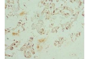 Immunohistochemistry of paraffin-embedded human bladder cancer using ABIN7148657 at dilution of 1:100 (CFDP1 抗体  (AA 1-299))
