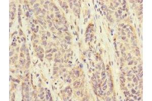Immunohistochemistry of paraffin-embedded human ovarian cancer using ABIN7152671 at dilution of 1:100 (FCRL6 抗体  (AA 20-307))