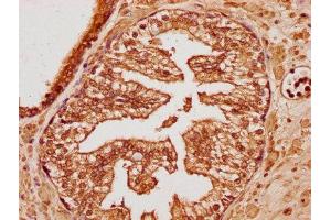 IHC image of ABIN7173475 diluted at 1:100 and staining in paraffin-embedded human endometrial cancer performed on a Leica BondTM system. (TRIM65 抗体  (AA 290-517))