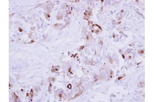 IHC-P Image Immunohistochemical analysis of paraffin-embedded human breast cancer, using MMP1, antibody at 1:250 dilution. (MMP1 抗体)