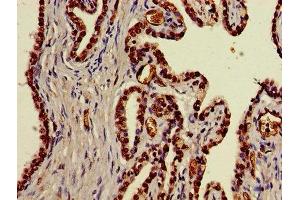 Immunohistochemistry of paraffin-embedded human prostate cancer using ABIN7170614 at dilution of 1:100 (DDX39B 抗体  (AA 2-251))