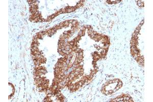 Formalin-fixed, paraffin-embedded human Prostate Carcinoma stained with PMEPA1 Mouse Monoclonal Antibody (PMEPA1/2698). (PMEPA1 抗体)