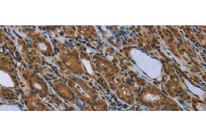 Immunohistochemistry of paraffin-embedded Human thyroid cancer using SMAD4 Polyclonal Antibody at dilution of 1/40 (SMAD4 抗体)