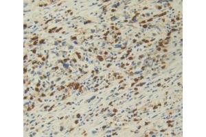 DAB staining on IHC-P; Samples: Human Stomach Cancer Tissue. (IL12A 抗体  (AA 23-219))