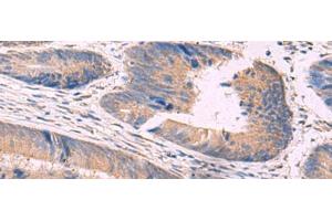 Immunohistochemistry of paraffin-embedded Human colorectal cancer tissue using NIPSNAP1 Polyclonal Antibody at dilution of 1:50(x200) (NIPSNAP1 抗体)