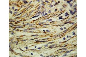 Anti-MMP16 antibody, IHC(P) IHC(P): Human Rectal Cancer Tissue (MMP16 抗体  (C-Term))