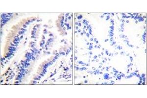 Immunohistochemistry analysis of paraffin-embedded human lung carcinoma tissue, using FADD (Ab-194) Antibody. (FADD 抗体  (AA 159-208))