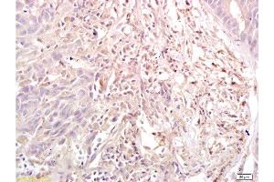 Formalin-fixed and paraffin embedded human gastric carcinoma labeled with Anti-Dnmt3a Polyclonal Antibody, Unconjugated  at 1:200, followed by conjugation to the secondary antibody and DAB staining (DNMT3A 抗体  (AA 26-100))