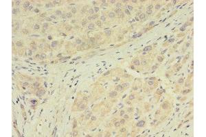 Immunohistochemistry of paraffin-embedded human liver cancer using ABIN7154076 at dilution of 1:100 (Glutathione Peroxidase 7 抗体  (AA 28-187))