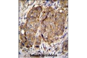 METTL2 Antibody (C-term) (ABIN655892 and ABIN2845293) immunohistochemistry analysis in formalin fixed and paraffin embedded human breast carcinoma followed by peroxidase conjugation of the secondary antibody and DAB staining. (METTL2 抗体  (C-Term))