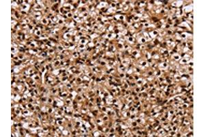 The image on the left is immunohistochemistry of paraffin-embedded Human prostate cancer tissue using ABIN7129718(HMGN5 Antibody) at dilution 1/20, on the right is treated with fusion protein. (HMGN5 抗体)
