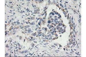 Immunohistochemical staining of paraffin-embedded Carcinoma of Human lung tissue using anti-SNAP25 mouse monoclonal antibody. (SNAP25 抗体)