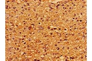 Immunohistochemistry of paraffin-embedded human glioma using ABIN7167523 at dilution of 1:100 (PTPRZ1 抗体  (AA 36-300))