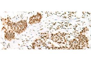 Immunohistochemistry of paraffin-embedded Human esophagus cancer tissue using TCOF1 Polyclonal Antibody at dilution of 1:50(x200) (TCOF1 抗体)
