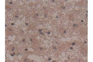 Detection of ANO6 in Human Glioma Tissue using Polyclonal Antibody to Anoctamin 6 (ANO6)