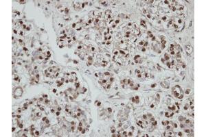 IHC-P Image Immunohistochemical analysis of paraffin-embedded human ovarian cancer, using SEPHS2, antibody at 1:100 dilution. (SEPHS2 抗体)