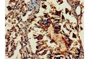Immunohistochemistry of paraffin-embedded human lung tissue using ABIN7154436 at dilution of 1:100 (GAB2 抗体  (AA 273-484))