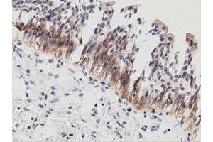 Immunohistochemical staining of paraffin-embedded Carcinoma of Human thyroid tissue using anti-PECR mouse monoclonal antibody. (PECR 抗体)