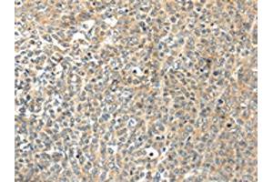 The image on the left is immunohistochemistry of paraffin-embedded Human ovarian cancer tissue using ABIN7192947(TSPYL6 Antibody) at dilution 1/20, on the right is treated with synthetic peptide. (TSPY-Like 6 抗体)
