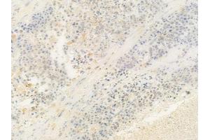 ABIN6263052 and ABIN6278809 at 1/100 staining human prostate carcinoma by IHC-P. (MAFB 抗体  (C-Term))