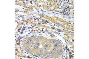 Immunohistochemistry of paraffin-embedded human gastric cancer using PICK1 antibody. (PICK1 抗体)