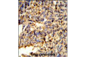 Formalin-fixed and paraffin-embedded human lung carcinoma reacted with FCGR2C Antibody , which was peroxidase-conjugated to the secondary antibody, followed by DAB staining. (FCGR2C 抗体  (C-Term))