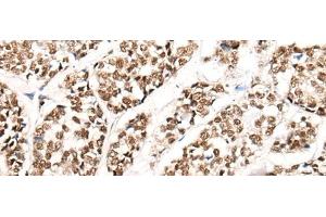 Immunohistochemistry of paraffin-embedded Human esophagus cancer tissue using HGH1 Polyclonal Antibody at dilution of 1:45(x200) (FAM203B 抗体)