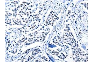 The image on the left is immunohistochemistry of paraffin-embedded Human breast cancer tissue using ABIN7191961(POU2AF1 Antibody) at dilution 1/15, on the right is treated with synthetic peptide. (POU2AF1 抗体)