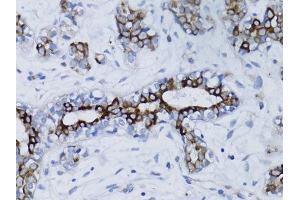 Immunohistochemistry of paraffin-embedded human breast cancer using BRCA1 antibody. (BRCA1 抗体  (AA 120-220))