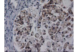 Immunohistochemical staining of paraffin-embedded Adenocarcinoma of Human colon tissue using anti-GPHN mouse monoclonal antibody. (Gephyrin 抗体)