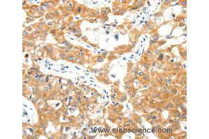 Immunohistochemistry of Human lung cancer using TRAF3 Polyclonal Antibody at dilution of 1:40 (TRAF3 抗体)