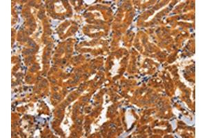 The image on the left is immunohistochemistry of paraffin-embedded Human thyroid cancer tissue using ABIN7192830(TNFRSF8 Antibody) at dilution 1/60, on the right is treated with synthetic peptide.