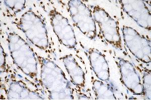 Immunohistochemistry was performed on paraffin-embedded human sigmoid colon carcinoma using histone H3 (di methyl K79) antibody (ABIN7798956), 1:200).