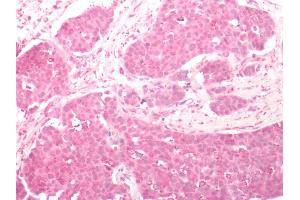 Human Breast Carcinoma: Formalin-Fixed, Paraffin-Embedded (FFPE) (FZD2 抗体  (N-Term))