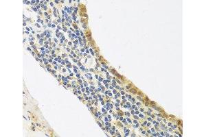 Immunohistochemistry of paraffin-embedded Human lung cancer using Endothelin 1 Polyclonal Antibody at dilution of 1:100 (40x lens). (Endothelin 1 抗体)