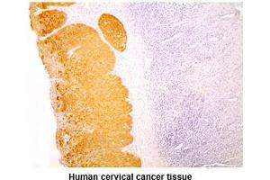 Paraffin embedded sections of human cervical cancer tissue were incubated with anti-human KRT14 (1:200) for 2 hours at room temperature. (KRT14 抗体)