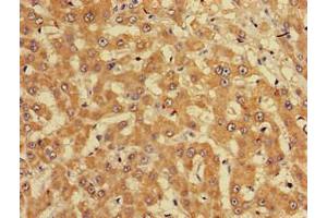 Immunohistochemistry of paraffin-embedded human liver cancer using ABIN7165226 at dilution of 1:100 (CUTA 抗体  (AA 33-150))