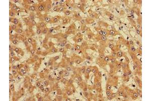 Immunohistochemistry of paraffin-embedded human liver cancer using ABIN7165226 at dilution of 1:100