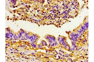Immunohistochemistry of paraffin-embedded human lung cancer using ABIN7160458 at dilution of 1:100 (PRTN3 抗体  (AA 1-170))