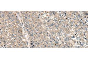 Immunohistochemistry of paraffin-embedded Human liver cancer tissue using CC2D1A Polyclonal Antibody at dilution of 1:35(x200) (CC2D1A 抗体)