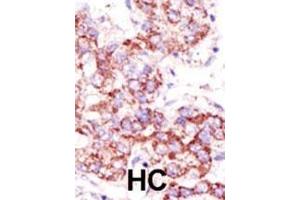 Formalin-fixed and paraffin-embedded human cancer tissue reacted with the primary antibody, which was peroxidase-conjugated to the secondary antibody, followed by AEC staining. (USP4 抗体  (C-Term))