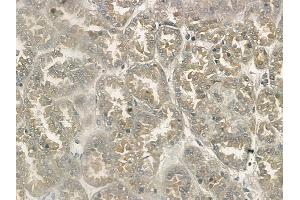 ABIN6264549 and ABIN6272406 at 1/100 staining human renal cell carcinoma by IHC-P.