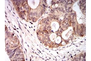 Immunohistochemical analysis of paraffin-embedded colon cancer tissues using CPV-VP2 mouse mAb with DAB staining. (CPV-VP2 (AA 1-128) 抗体)