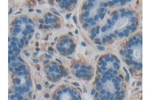 Detection of FASL in Human Breast cancer Tissue using Polyclonal Antibody to Factor Related Apoptosis Ligand (FASL)
