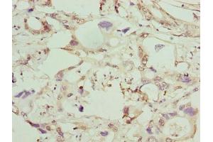 Immunohistochemistry of paraffin-embedded human pancreatic cancer using ABIN7154064 at dilution of 1:100 (GGTLC1 抗体  (AA 1-225))