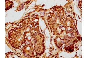 IHC image of ABIN7150773 diluted at 1:200 and staining in paraffin-embedded human breast cancer performed on a Leica BondTM system. (DUSP4 抗体  (AA 109-198))