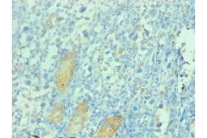 Immunohistochemical of paraffin-embedded human gastric cancer tissue using ABIN7163025 at dilution of 1:200 (PGC 抗体)