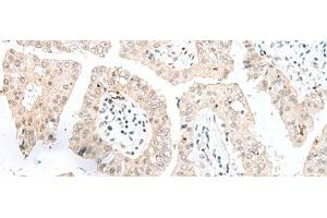 Immunohistochemistry of paraffin-embedded Human liver cancer tissue using NGEF Polyclonal Antibody at dilution of 1:35(x200) (NGEF 抗体)