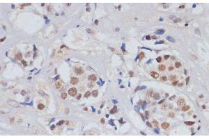Immunohistochemistry of paraffin-embedded Human breast cancer using SKIV2L2 Polyclonal Antibody at dilution of 1:100 (40x lens). (MTR4 抗体)